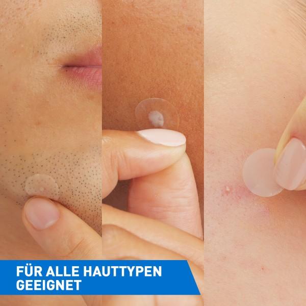 Actual product image CeraVe Anti-Unreinheiten Patches (Cleansing lotion)
