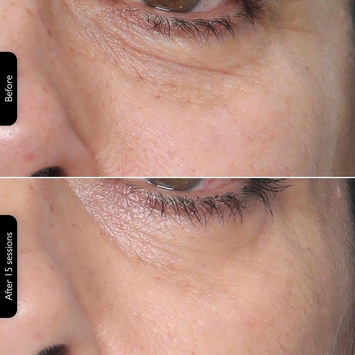 Actual product image Silk'n FaceTite MultiPlatform anti-ageing device