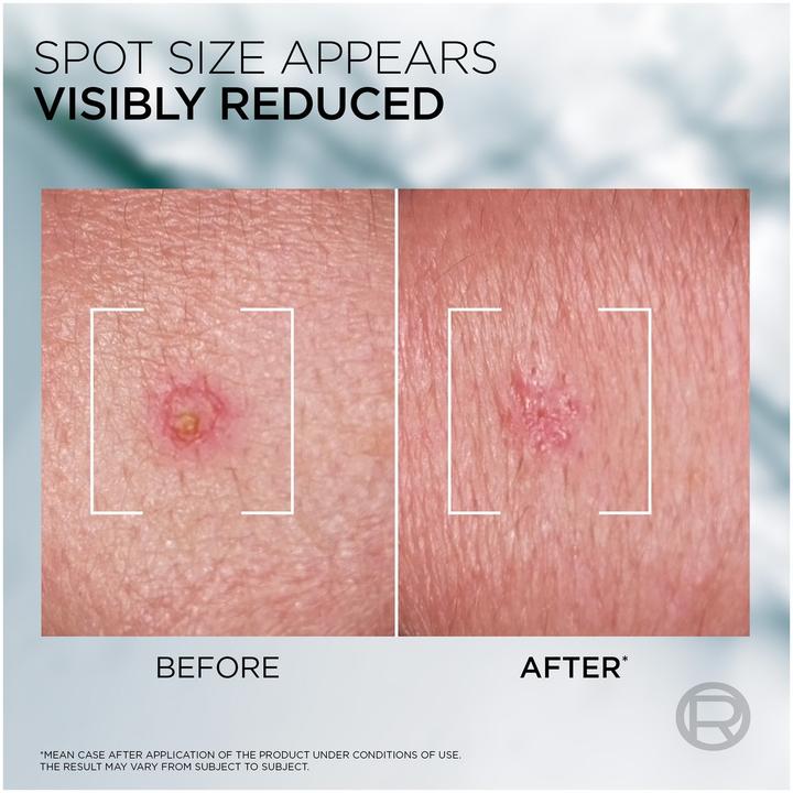 Actual product image L'Oréal Paris Men Expert Derma Control S.O.S Pimple Paste (45 ml)