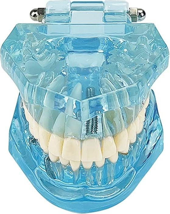 Produktbild Youya Dental Dental-Modell für Krankheitslehre, entfernbarer Zahn