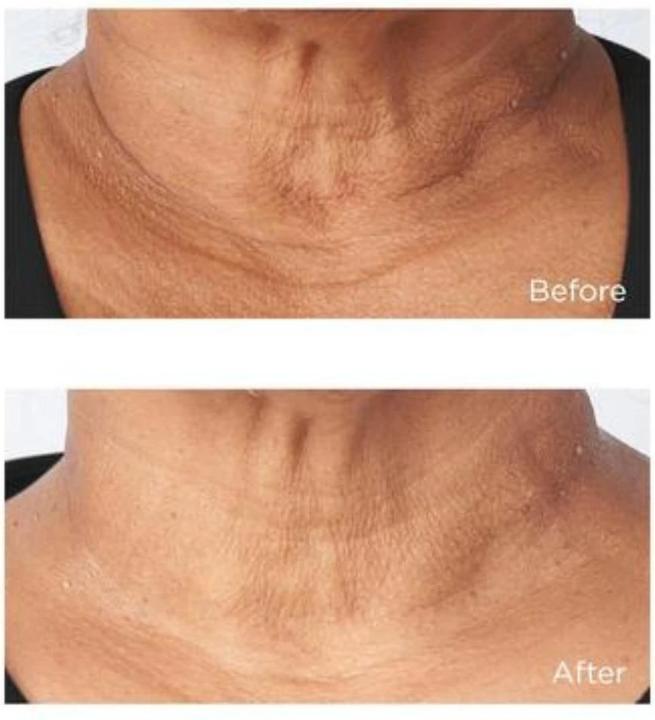 Produktbild Perricone MD Cold Plasma Sub/D Chin & Neck 59 ml (59 ml)
