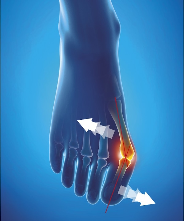Actual product image Epitact Correction Bandage Hallux Valgus (S)