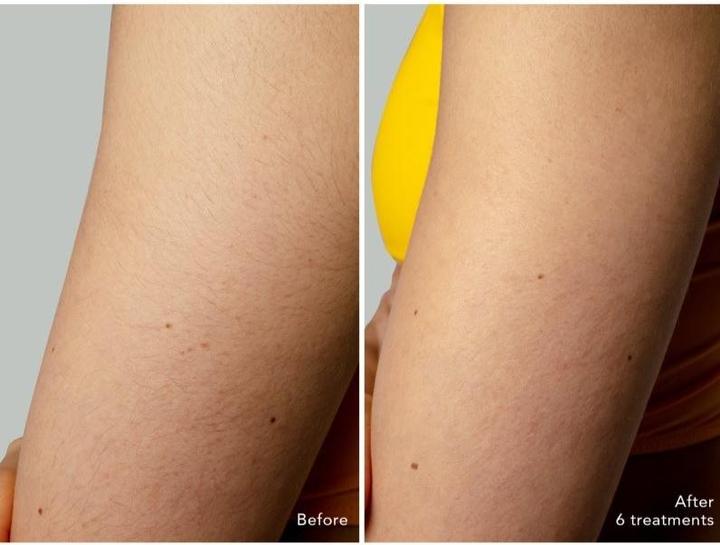 Image du produit Foreo PEACH 2 Go Système d'épilation à la lumière pulsée pour femmes - 1 pièce, Peach