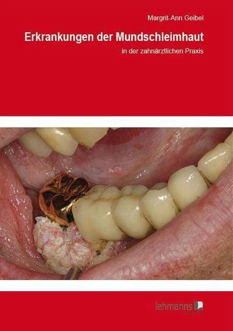 Produktbild Erkrankungen der Mundschleimhaut (Deutsch, Margrit-Ann Geibel, 2014)