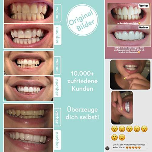 Actual product image UniqueSmile Teeth Whitening (Bleaching kit)