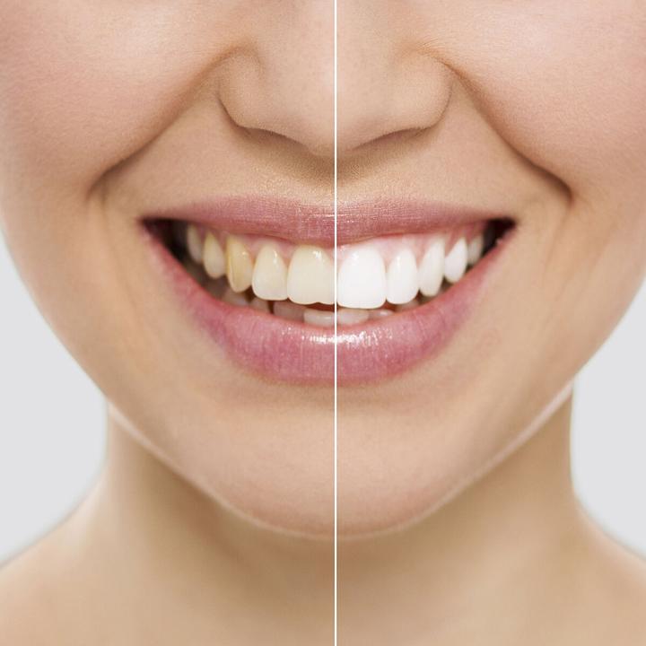 Actual product image InnovaGoods Tooth whitening strips Wripes (Bleaching Strips)