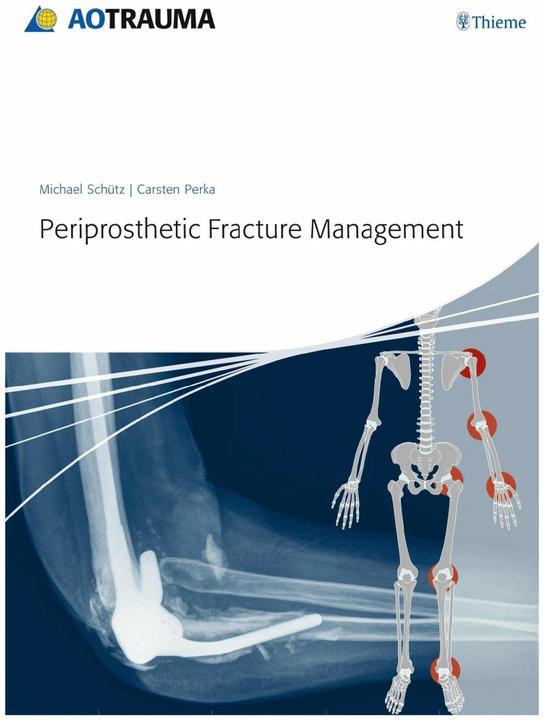 Produktbild Periprosthetic Fracture Management (Englisch, Carsten Perka, Michael Schütz, 2013)