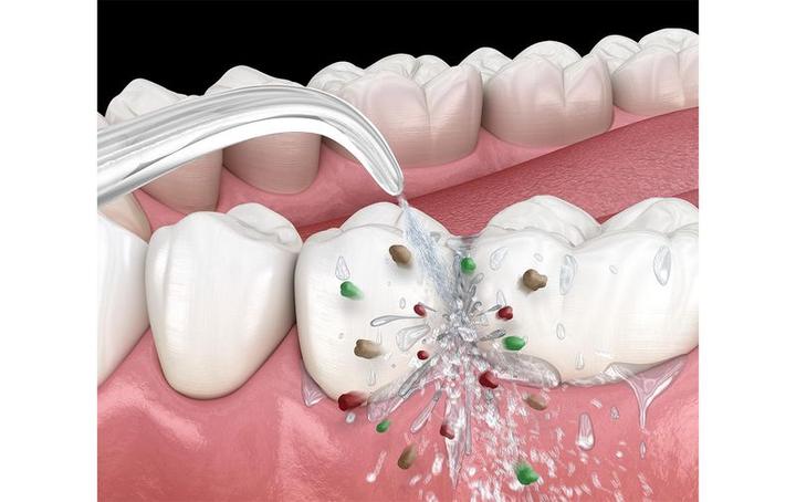 Produktbild Silk'n Munddusche-Set OptiFloss