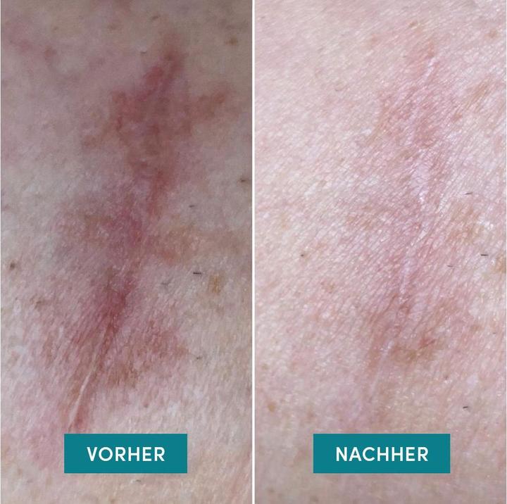 Produktbild Apricot Narbenpads