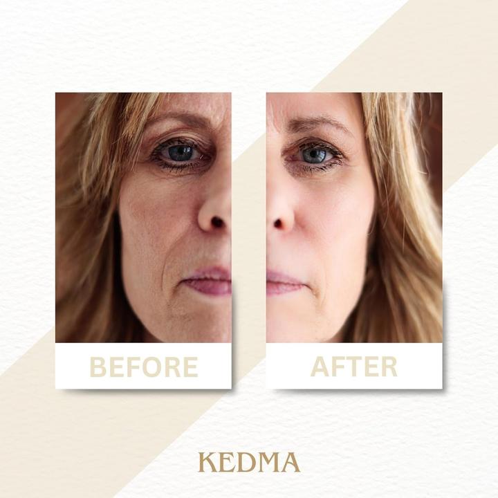 Actual product image Kedma Instant Wrinkle Filler with Platinum and Hyaluronic Acid for Smoothing and Moisturizing