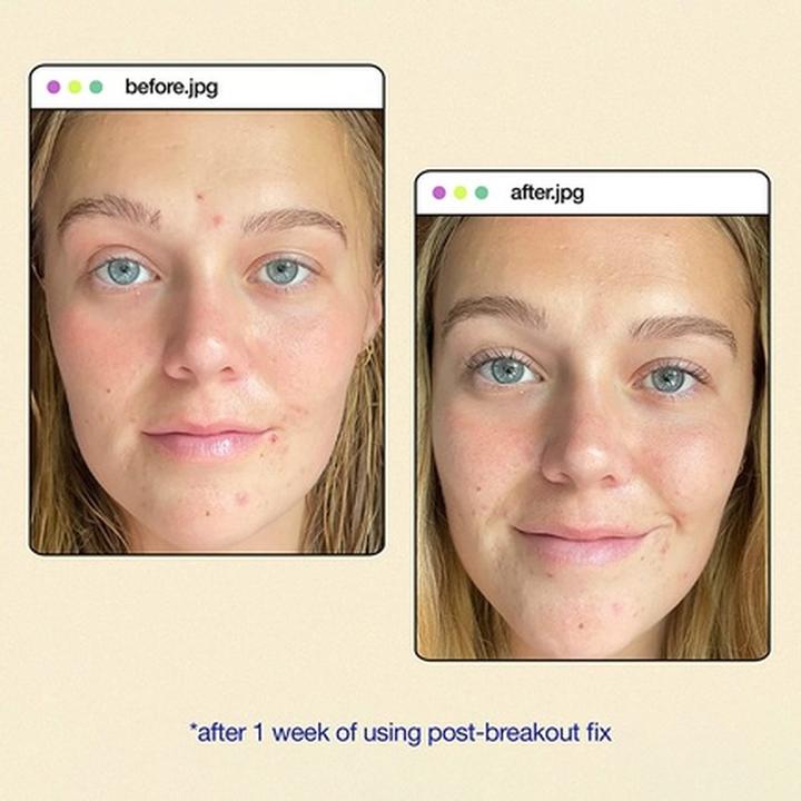 Produktbild Dermalogica Clear Start - Post-Breakout Fix (Körpercreme)