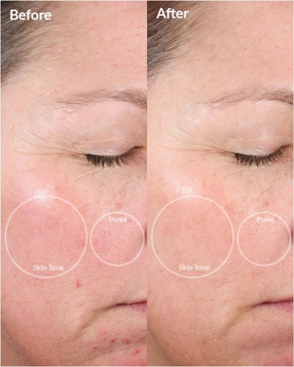Produktbild PMD Personal Microderm Pro Berry