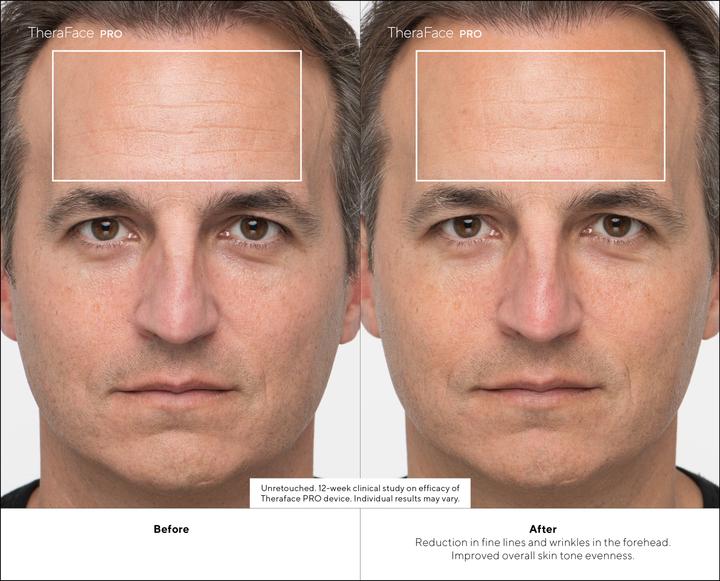 Immagine prodotto Therabody TheraFace Pro