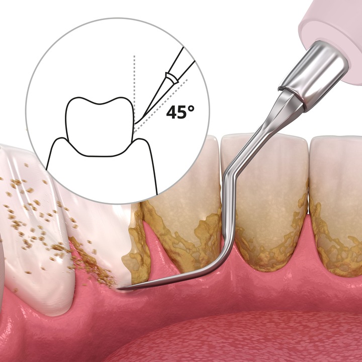 Image du produit Ailoria Deplaqued (Nettoyeur de dents sonique)