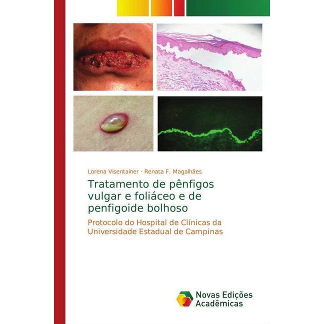 Tratamento de pênfigos vulgar e foliáceo e de penfigoide bolhoso, Fachbücher von Renata F. Magalhães, Lorena Visentainer