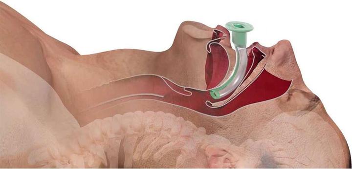 Actual product image Intersurgical Disposable Guedel tube size 0, grey, ISO 5.5