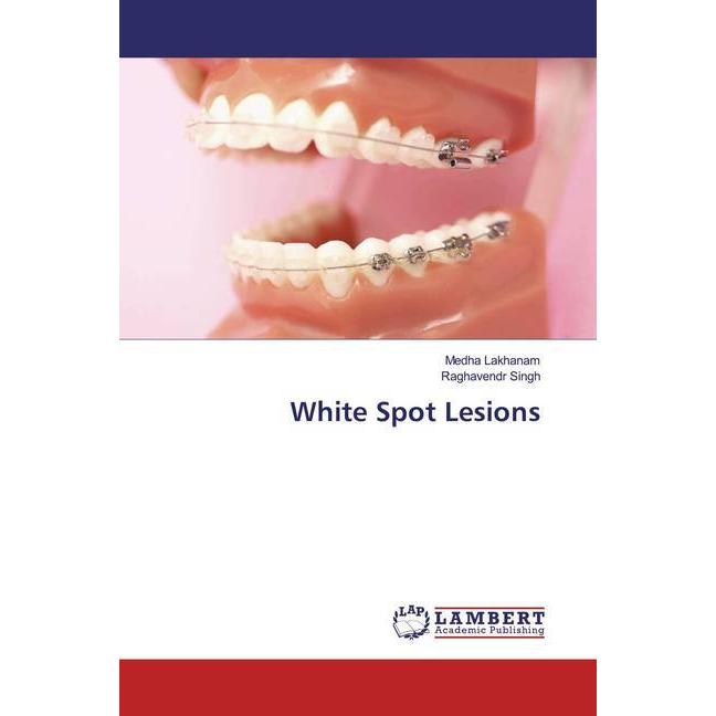 Thumbnail - White Spot Lesions, Fachbücher von Medha Lakhanam, Raghavendr Singh