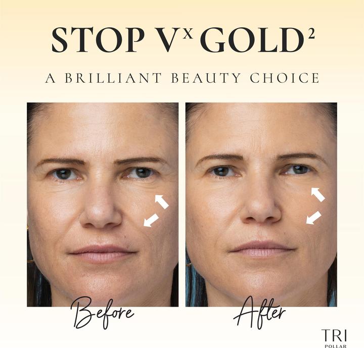 Image du produit TriPollar VX Gold2 soin ultime de la peau anti-âge RF-DMA