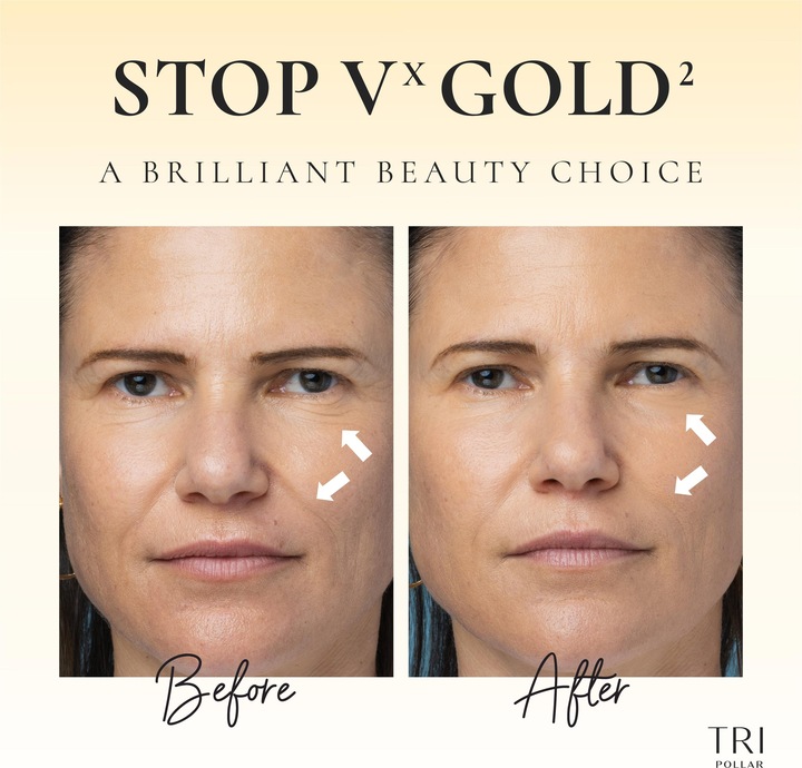 Actual product image TriPollar VX Gold2 ultimate skin care anti ageing RF-DMA