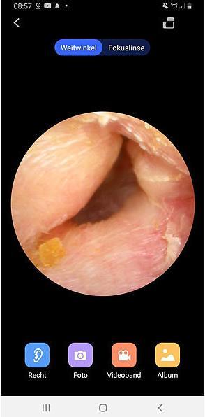 Produktbild Newgen medicals WLAN-Ohrreiniger mit Full-HD-Kamera