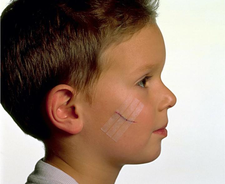 Actual product image Nexcare Steri-Strip wound closure strips (6 x)