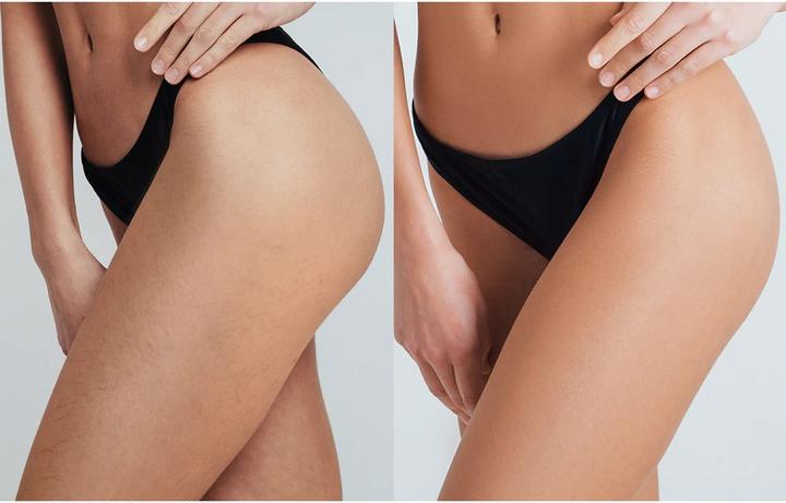 Actual product image Foreo Peach 2 Pro Max (IPL Hair Removal Device, 1 unit, Professional Home Use)