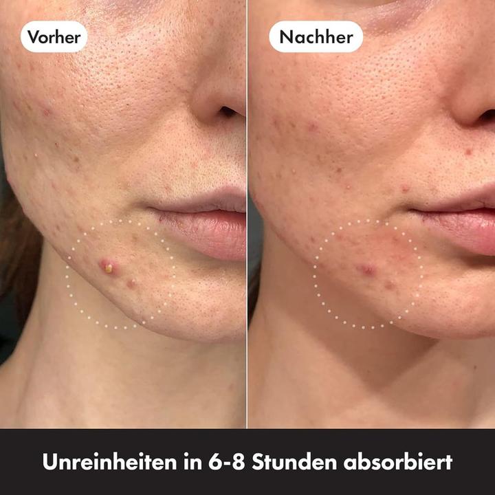 Image du produit Hero.Mighty Patch The Original 24 (235.20 ml)