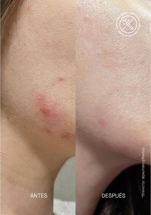 Actual product image Acnemy POSTZIT Corrector Serum (30 ml)