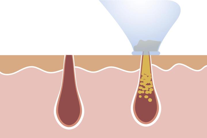 Actual product image MediaShop Derma Suction