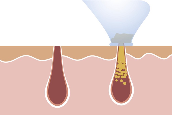 Produktbild MediaShop Derma Suction