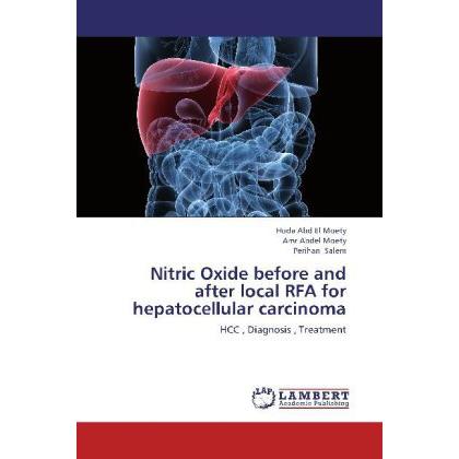 Nitric Oxide before and after local RFA for hepatocellular carcinoma, Fachbücher