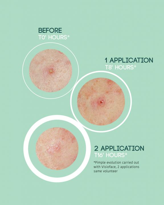 Image du produit Iroha Nature Nature SOS Pimple Patches (19.80 ml)