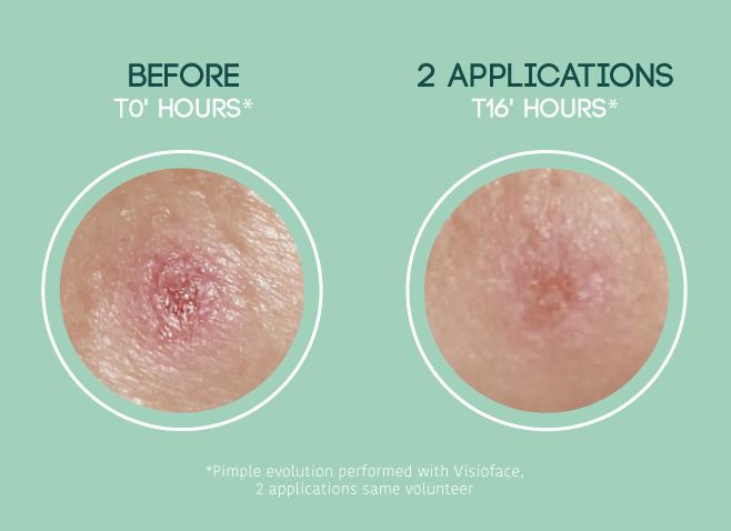 Image du produit Iroha Nature Nature SOS Pimple Patches (19.80 ml)