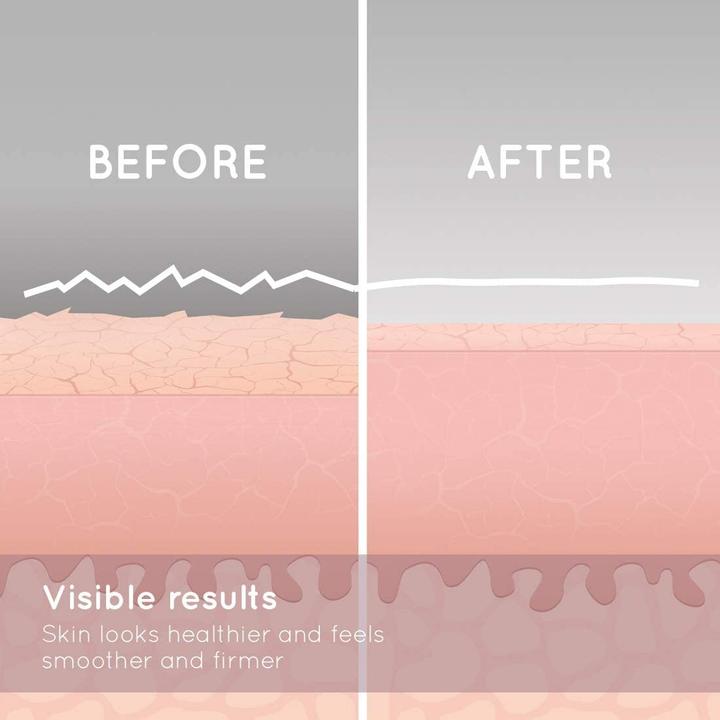 Image du produit Homedics HoMedic appareil de microdermabrasion MDA-100RG