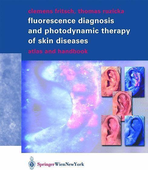 Produktbild Fluorescence Diagnosis and Photodynamic Therapy of Skin Diseases (Englisch, Clemens Fritsch, Thomas Ruzicka, 2013)