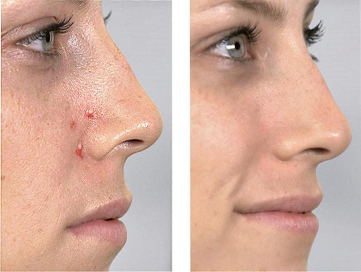 Actual product image MediaShop Derma Suction