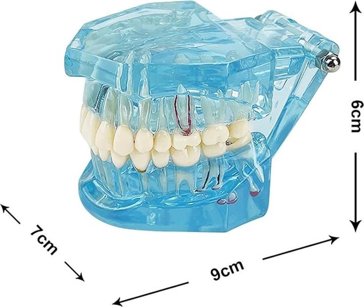 Produktbild Youya Dental Dental-Modell für Krankheitslehre, entfernbarer Zahn