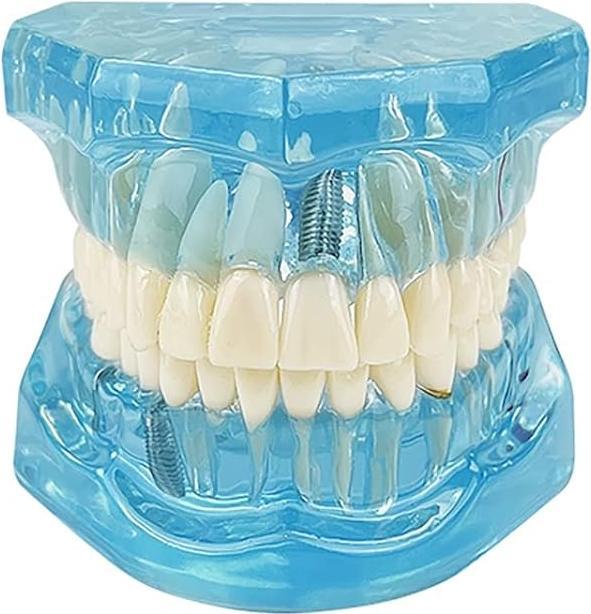 Youya Dental Dental-Modell für Krankheitslehre, entfernbarer Zahn