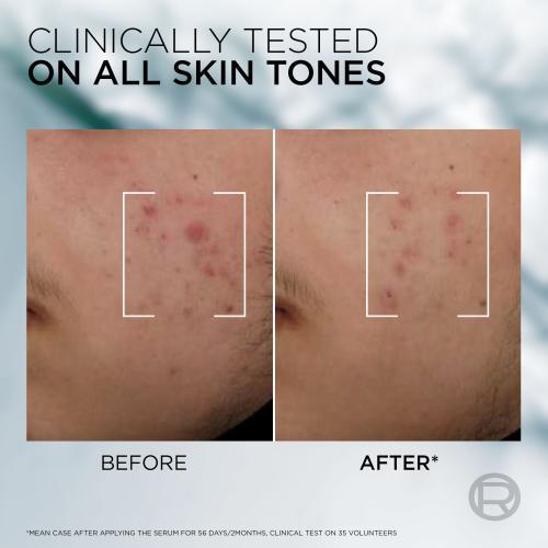 Actual product image L'Oréal Paris Men Expert Derma Control Anti-Blemish Serum (30 ml)