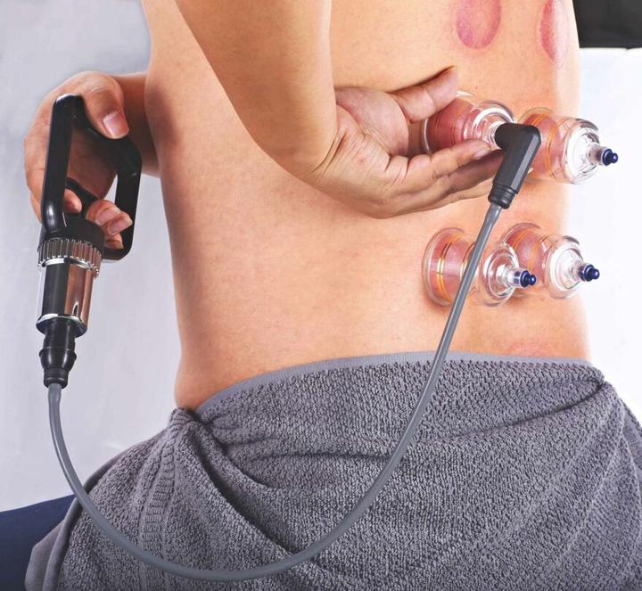 Actual product image AcuTop Cupping set, 19 pieces