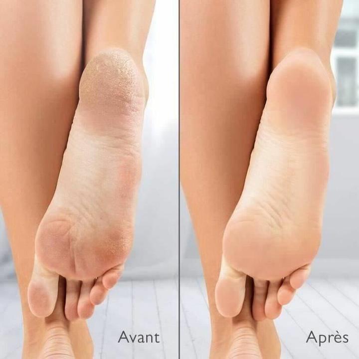 Actual product image Silk'n VacuPedi