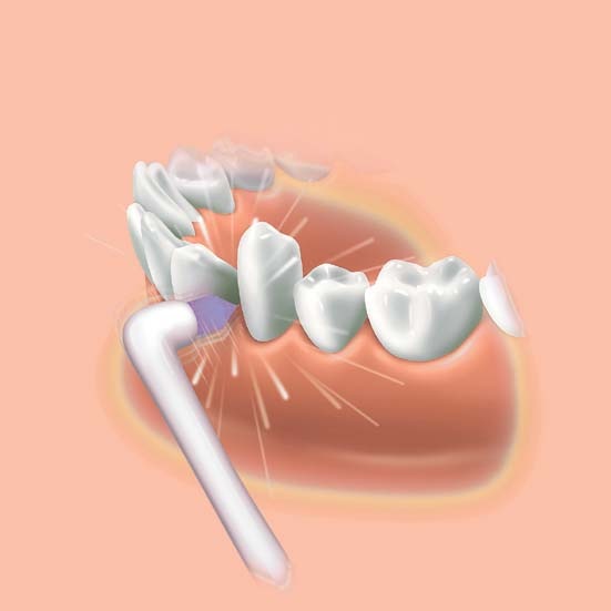 Actual product image Panasonic Ew0940 (Oral irrigator attachments)