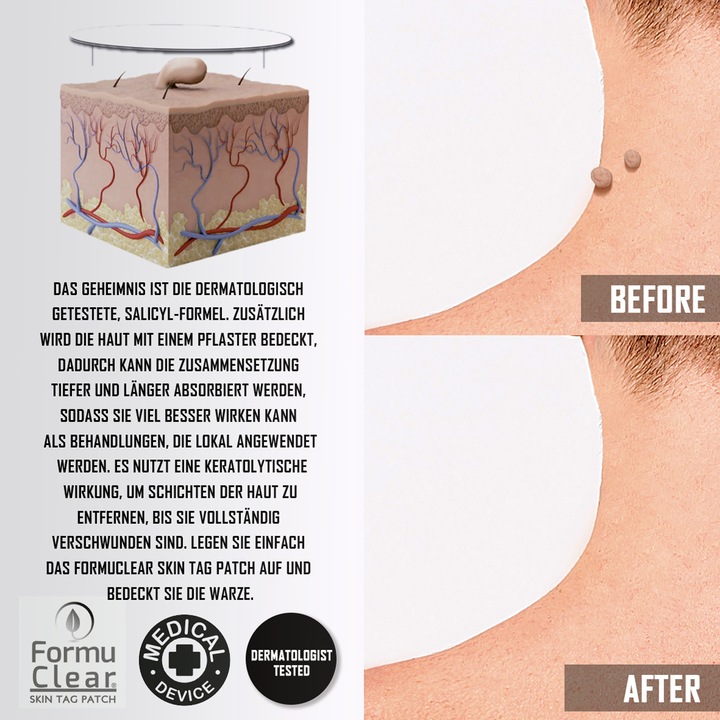 Immagine prodotto Formu Clear Skin Tag Patch (Deodorante per piedi e polvere)