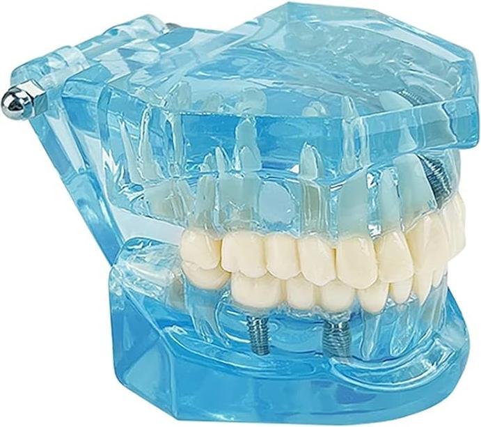 Produktbild Youya Dental Dental-Modell für Krankheitslehre, entfernbarer Zahn