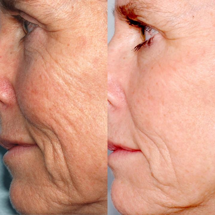 Actual product image PMD Beauty Personal Microderm Pro