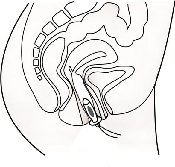 Produktbild Promed IT-6 Inkontinenz-Therapiegerät inkl. Vaginalsonde (1 x)