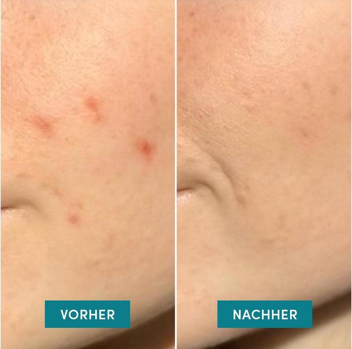 Actual product image Apricot Post Pimple Patches "fade away"