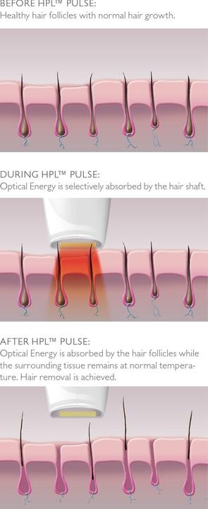 Produktbild Silk'n HPL-Haarentferner Jewel Luxx