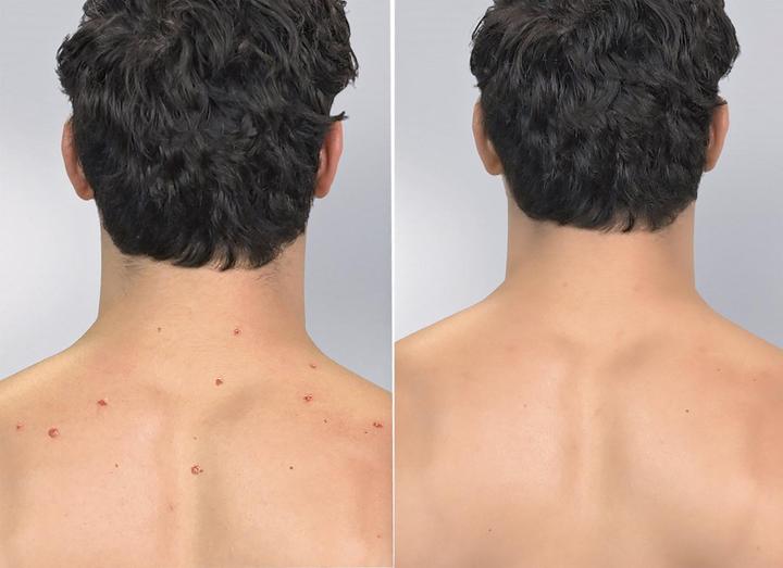 Actual product image MediaShop Derma Suction