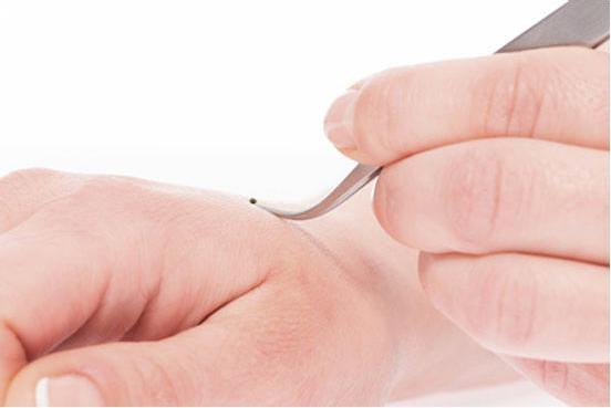 Actual product image Canal instrumente Tick tweezers